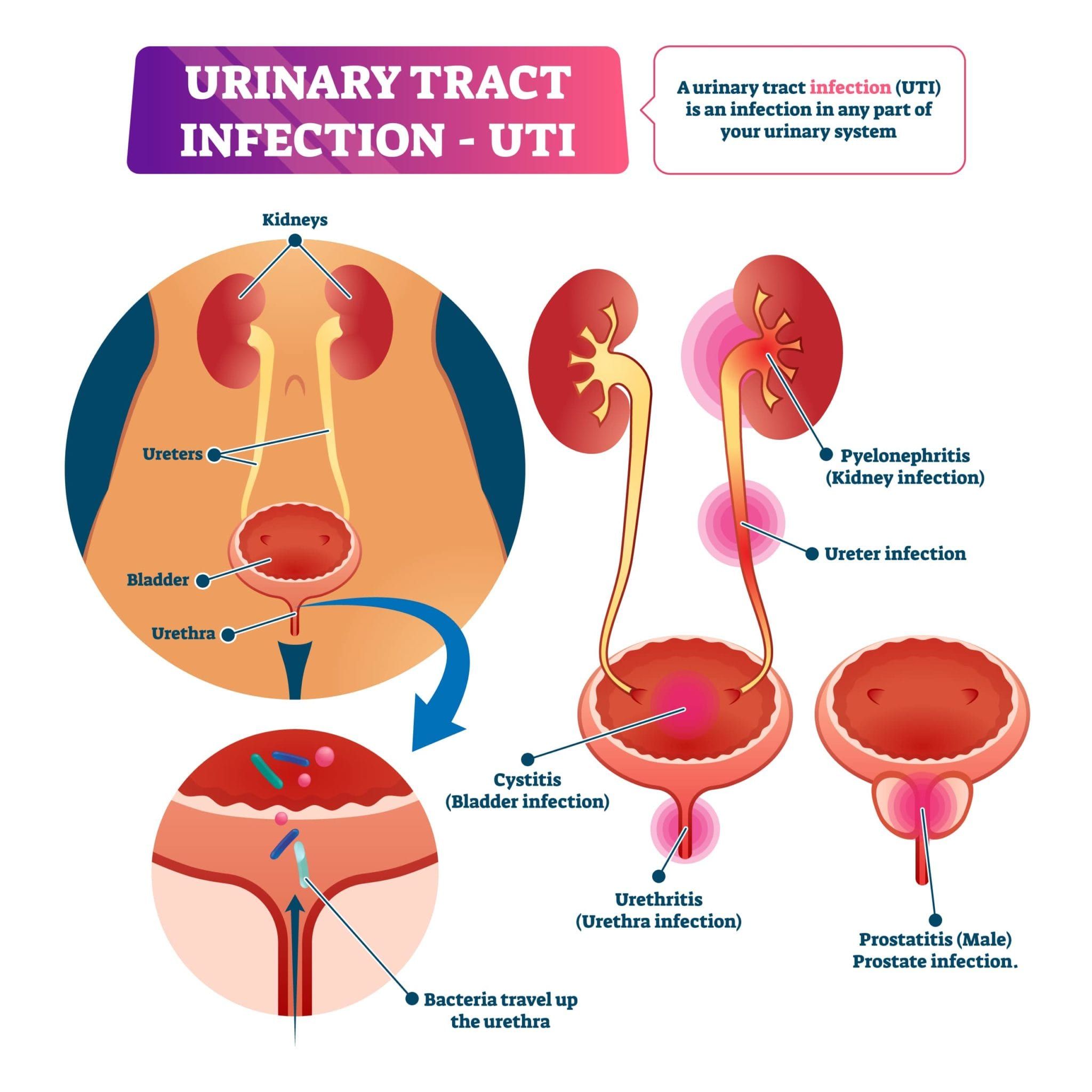what to do for a uti
