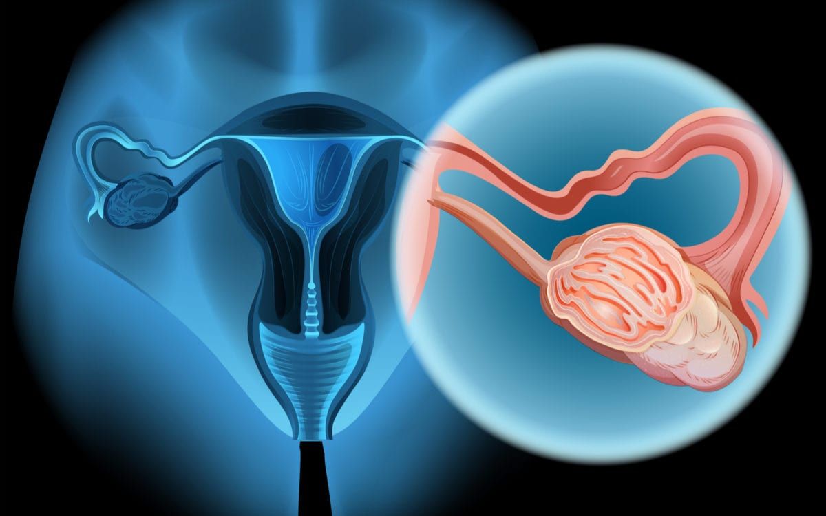 Ovarian Cancer Image